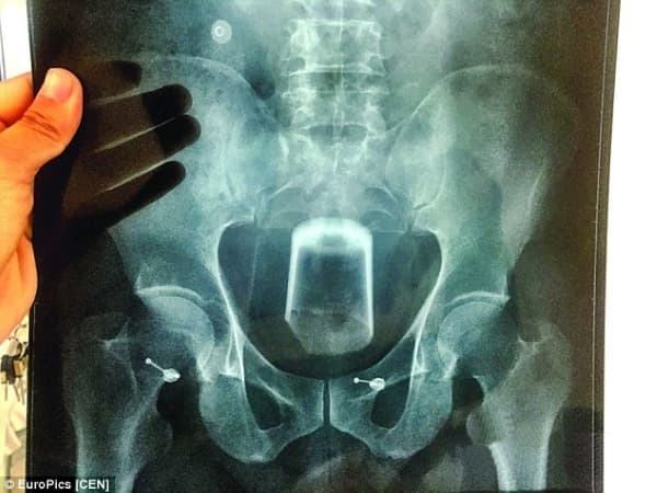 FOTO: Homem insere copo de cerveja em seu ânus para "aliviar dor de barriga” e ele acaba preso em seu interior