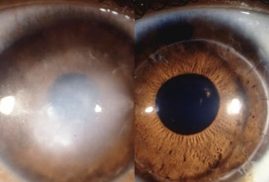 Cientistas podem encontrar a cura para a cegueira, revertendo a deterioração das células da retina; entenda