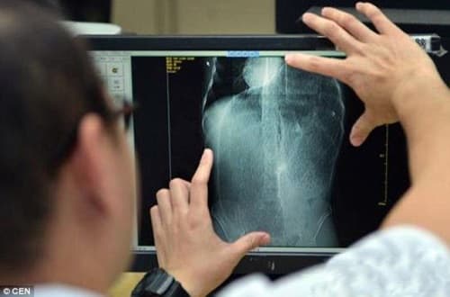 FOTO: Homem faz cirurgia para remover 5 kg de fezes de seu "mega intestino"