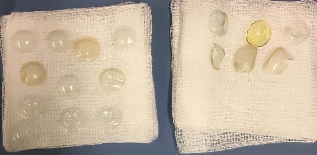 Médicos encontram 27 lentes de contato em olho de paciente