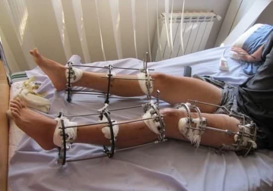 "TENDÊNCIA CRESCENTE" - FOTOS E VÍDEO: Método de cirurgia plástica quebra as pernas de pacientes para que fiquem mais altos