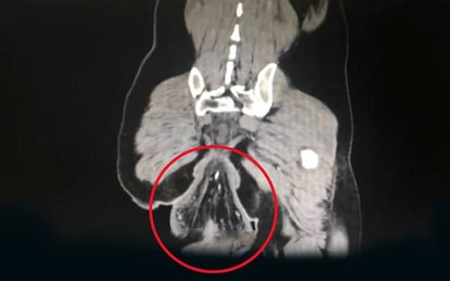 Distraído com celular, homem fica meia hora sentado na privada e seu reto ‘cai'