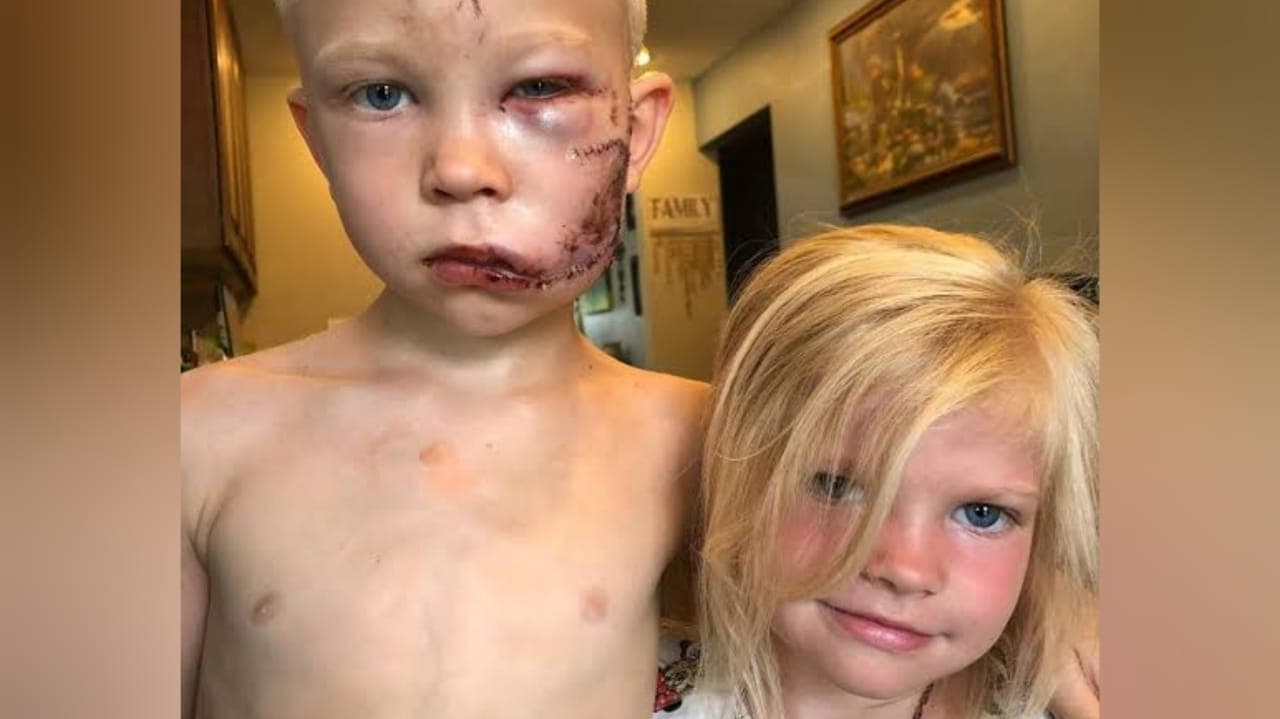 HERÓI VIRALIZOU: Menino de 6 anos salva a irmã de ataque de cachorro e fica com rosto desfigurado