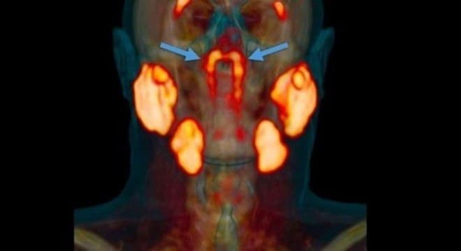 FOTOS: Cientistas dizem ter descoberto por acaso órgão misterioso no centro da cabeça humana