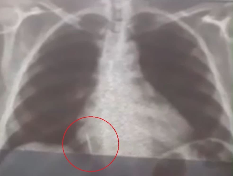 FOTO: Broca de dentista se solta durante atendimento e vai parar em pulmão de paciente no RN