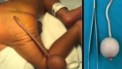 CASO RARO: Bebê brasileiro nasce com cauda de 12 cm e bola de 4 cm na extremidade