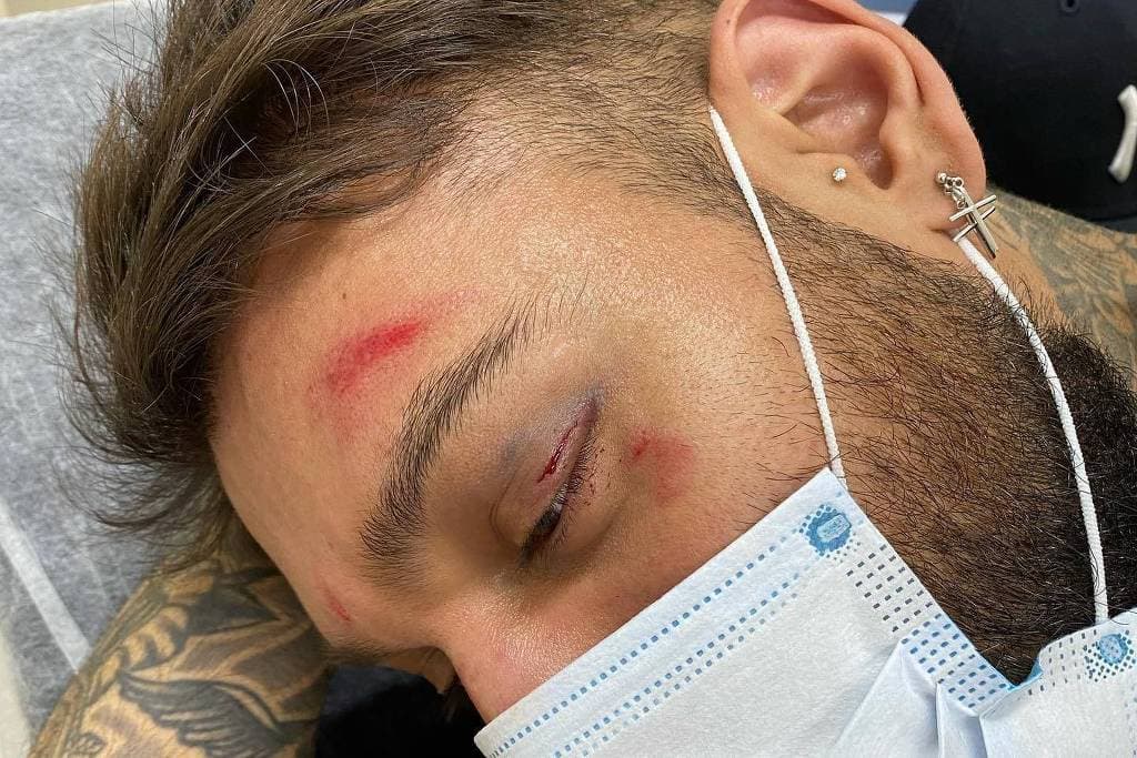 Lucas Lucco preocupa fãs após aparecer com o rosto machucado: ‘Bebi demais'