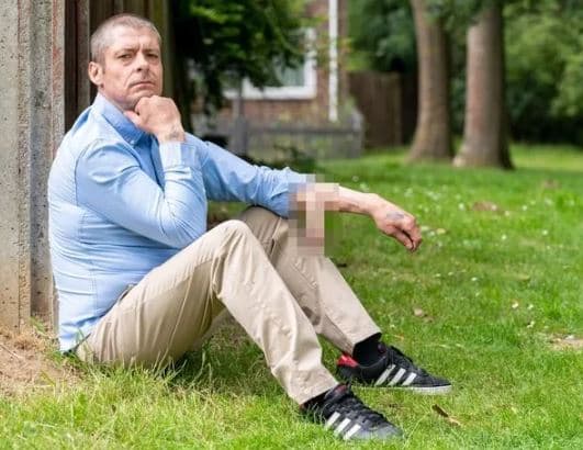 Homem celebra cirurgia peniana após viver com órgão anexado ao braço por 6 anos no Reino Unido