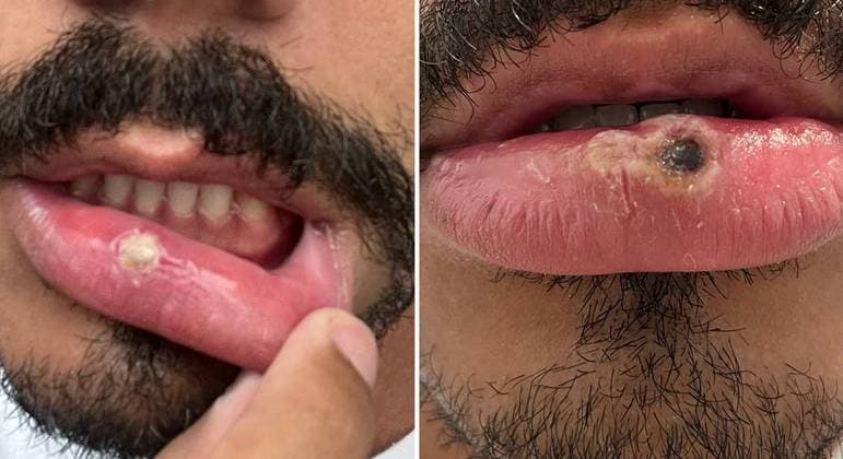 Varíola do macaco ‘está mais perto do que você imagina', diz homem com a doença internado em SP
