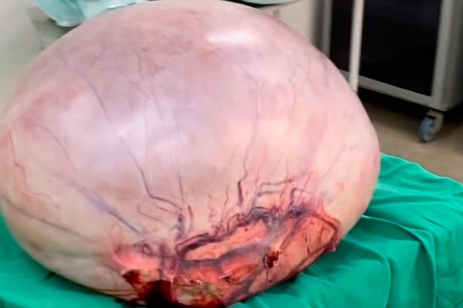 Paciente é operada para retirada de tumor de 10kg em Currais Novos; veja imagens
