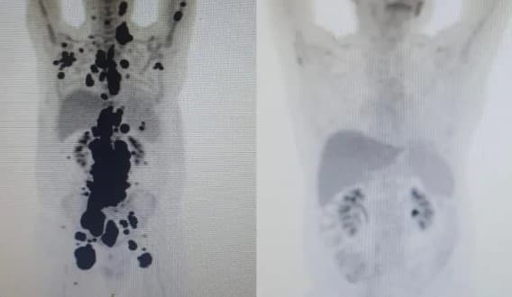 Terapia Car-T Cell: Anvisa autoriza estudo com tratamento revolucionário contra o câncer