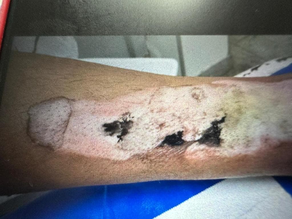 VÍDEO E FOTOS: Tornozeleira explode e causa ferimento de 3° grau em mulher