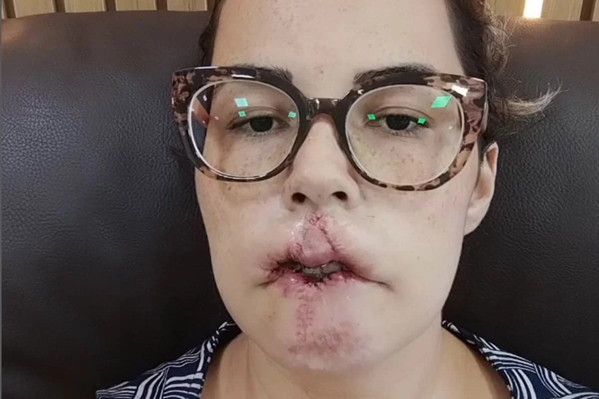 Mulher perde lábio após preenchimento: “Tristeza e raiva”