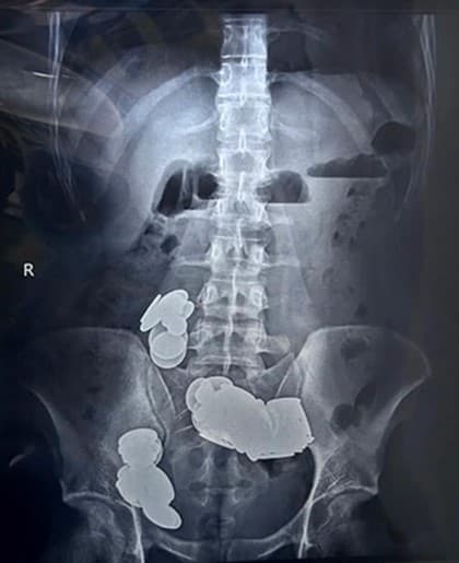 Médicos retiram 39 moedas e 37 ímãs do intestino de fisiculturista que os engoliu para ‘absorver zinco'