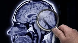 Alzheimer: Inteligência Artificial identifica fatores de risco com 7 anos de antecedência