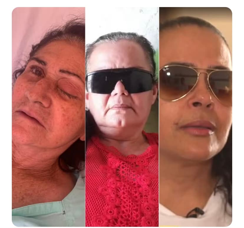 ‘Fui na esperança de enxergar': veja relatos de pacientes infectados em mutirão de cataratas no RN
