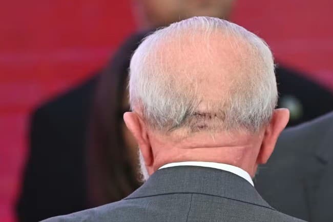 Exame feito 12 dias após queda aponta estabilidade, mas Lula deve seguir trabalhando em Brasília e repetir testes, diz equipe médica