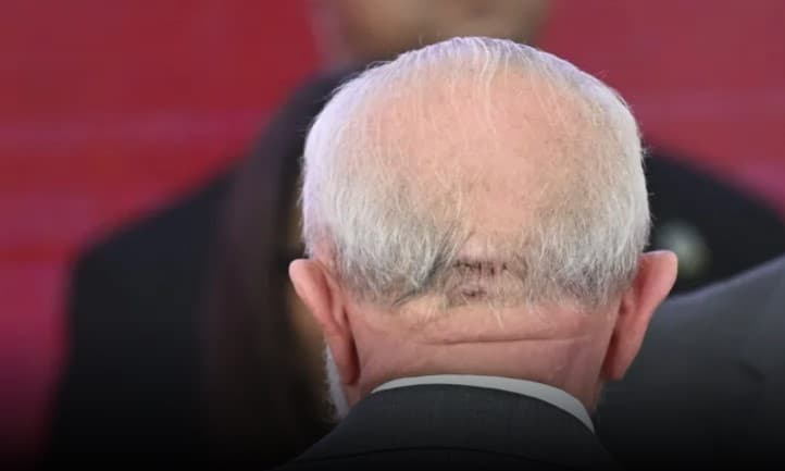 Com cicatriz na cabeça, Lula participa de primeiro evento após queda