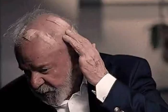 Lula mostra curativos na cabeça após cirurgias de emergência em SP
