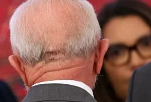 Lula deve passar por novo procedimento na noite desta quinta-feira