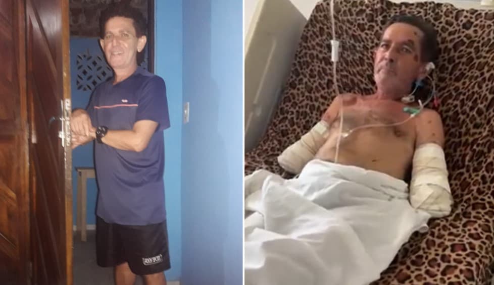 VÍDEO: Internado, homem que teve braços amputados após ataque de Pitbulls chora desesperado; ‘vaquinha' arrecada doações para a família