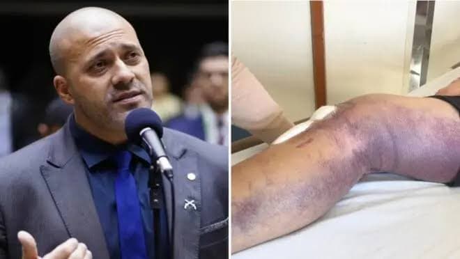 Daniel Silveira coloca tornozeleira para fazer tratamento fora de presídio
