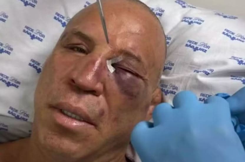 Wanderlei Silva quebra nariz e leva pontos após sofrer ‘nocaute’ na confusão depois da luta contra Popó