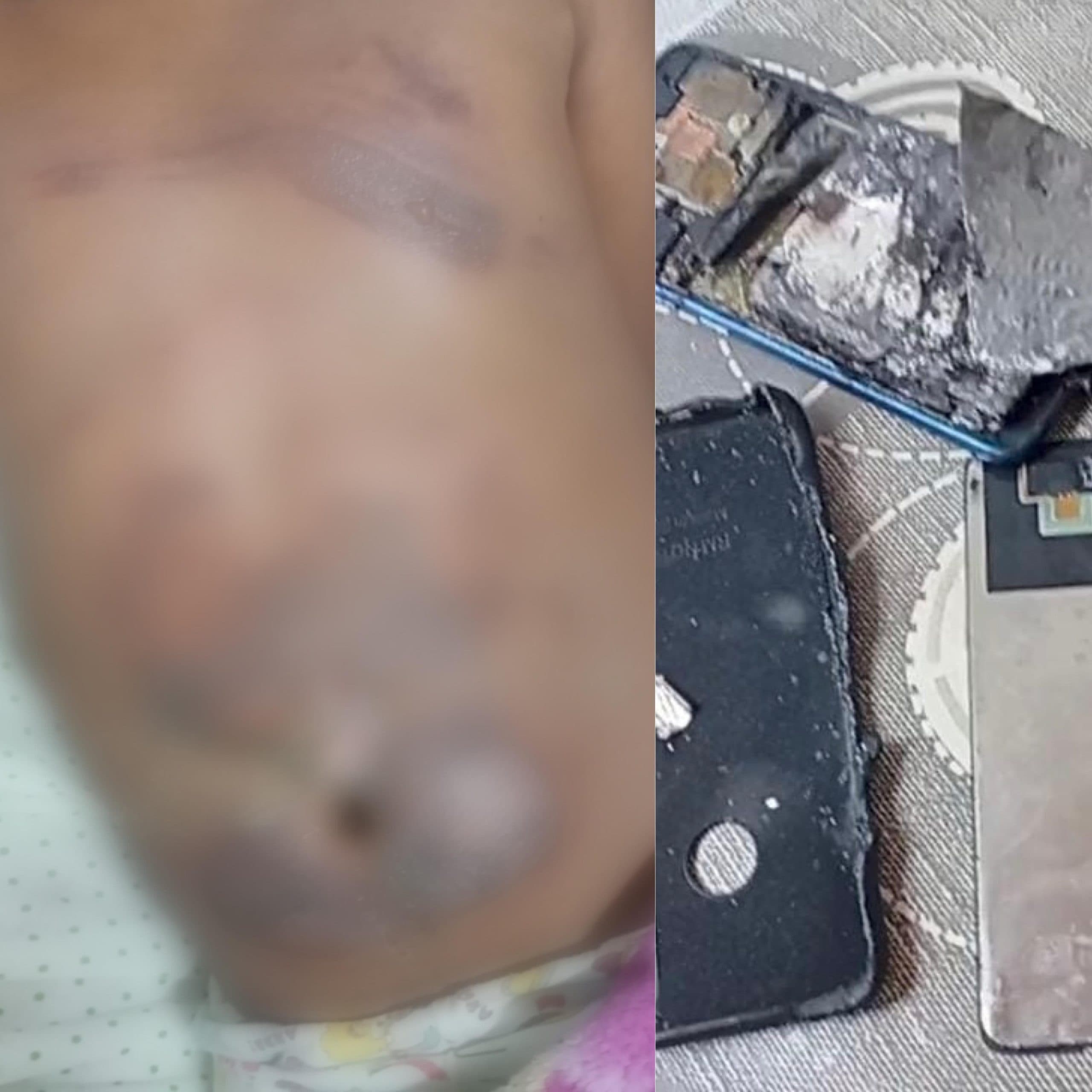 Criança de 10 anos sofre queimaduras após celular pegar fogo