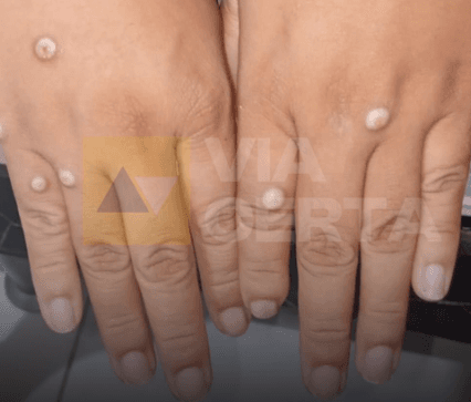 ALERTA: Mulher na Zona Norte de Natal testa positivo para mpox e entra em isolamento