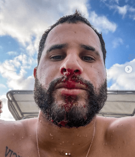 SURFE: Potiguar Ítalo Ferreira leva cinco pontos no nariz após acidente em Fiji