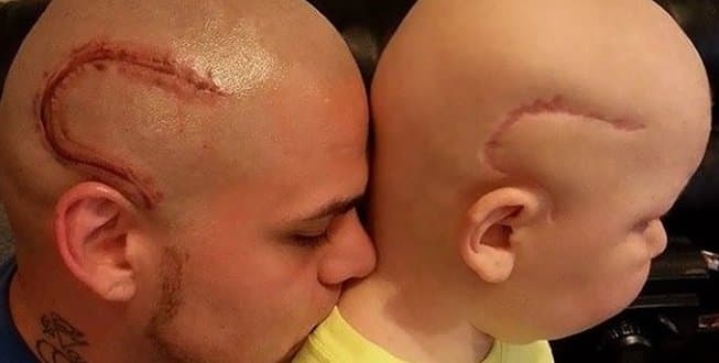 Pai tatua cicatriz em apoio a filho que enfrenta tumor no cérebro, e viraliza na Web