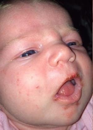 Bebê quase morre após contrair herpes labial por um beijo na boca