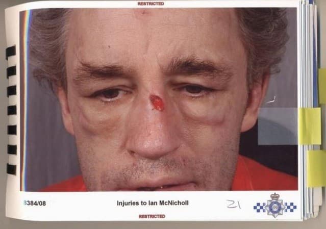 FOTOS: Homem é atacado com cigarro, martelo e água fervendo após se recusar a fazer sexo