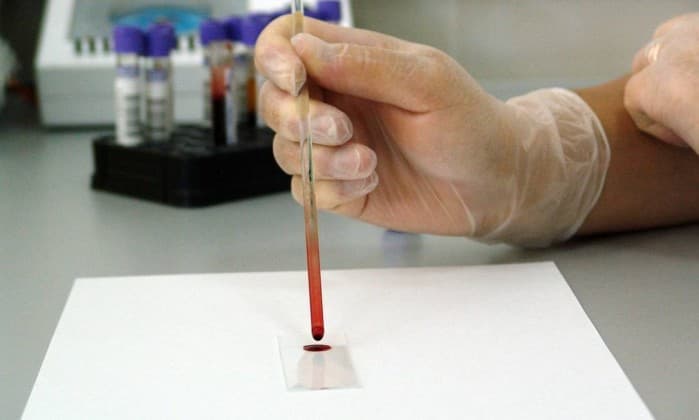 Moléculas promissoras são identificadas para o tratamento de leucemia, aponta estudo