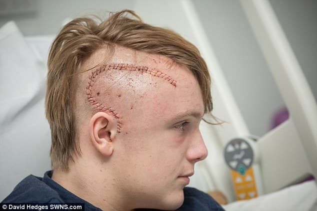 Adolescente tem epilepsia curada graças a uma cirurgia realizada por robô
