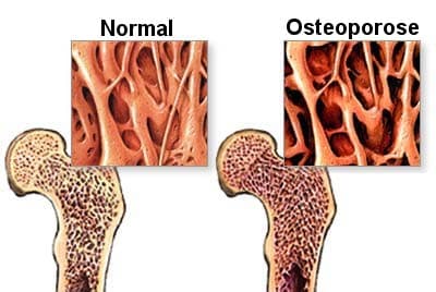 UFRN abre grupo terapêutico para pessoas com osteoporose