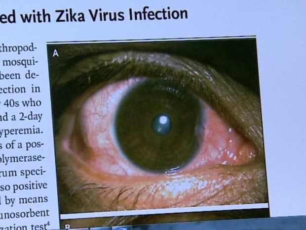 USP: zika causa infecção ligada ao glaucoma