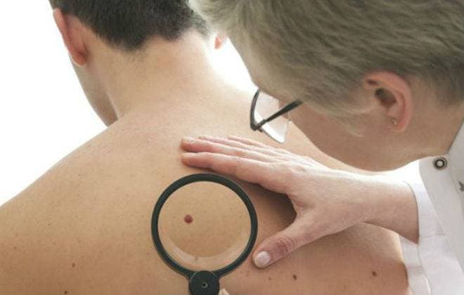 Vírus da herpes pode curar câncer de pele, dizem cientistas