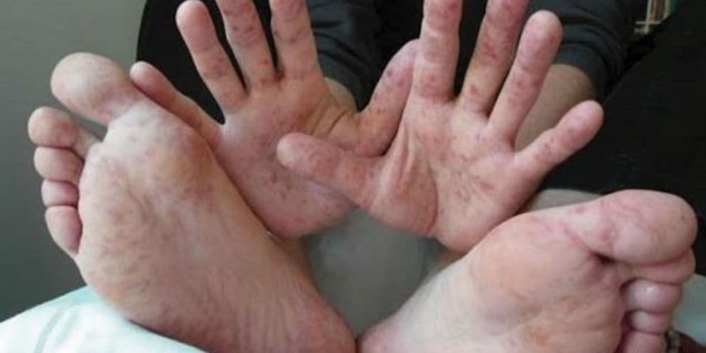 FOTOS: Cuidado com este vírus que está se espalhando em escolas e creches; conheça os sintomas e como evitá-lo