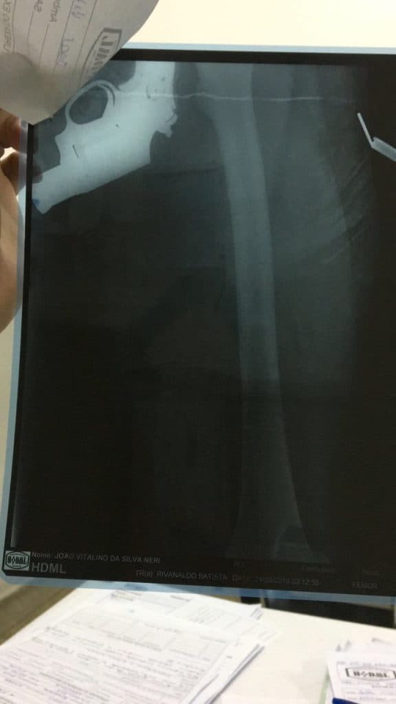 FOTO: Exame de raio-x flagra homem com revólver na cintura em hospital de Parnamirim