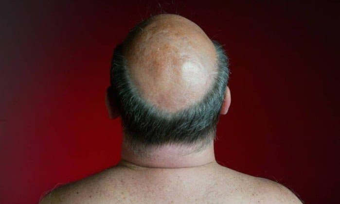 Pesquisadores encontram possível cura para a calvície através de remédio de osteoporose