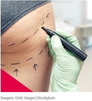 Do bumbum à vagina: por que as brasileiras são obcecadas por plásticas?