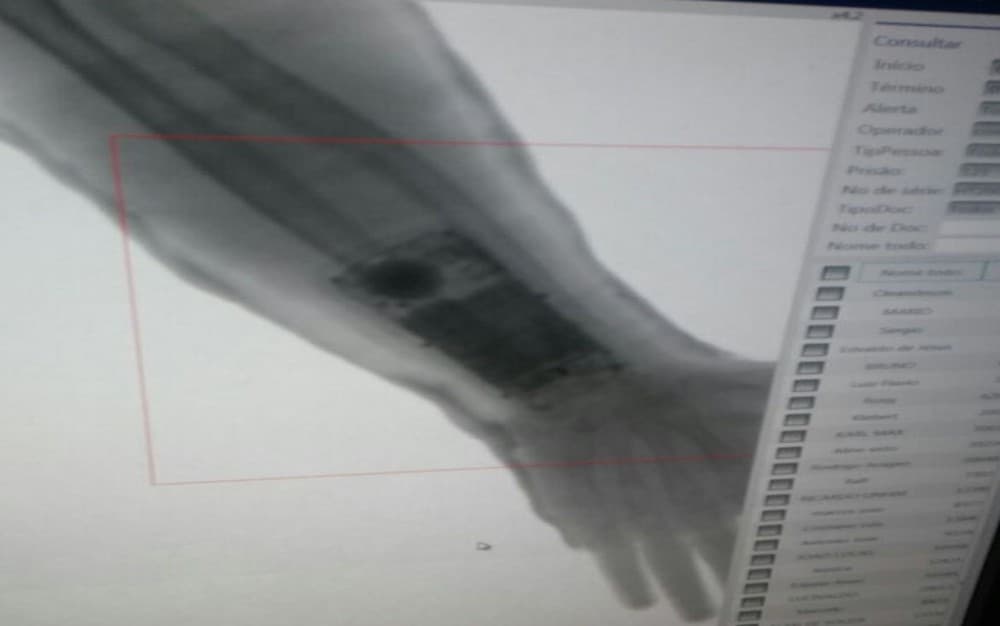 TRAPAÇA SEM LIMITE - (FOTO): Raio-x detecta celular em gesso para fraudar concurso da PM em Sergipe