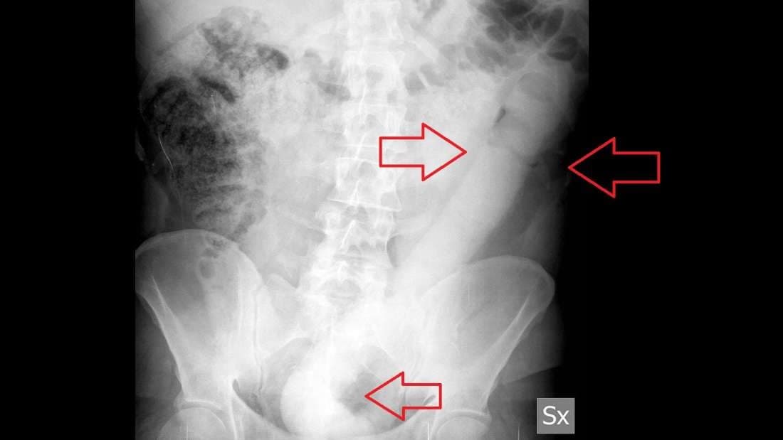 Médicos criam aparelho para retirar vibrador preso no reto de paciente
