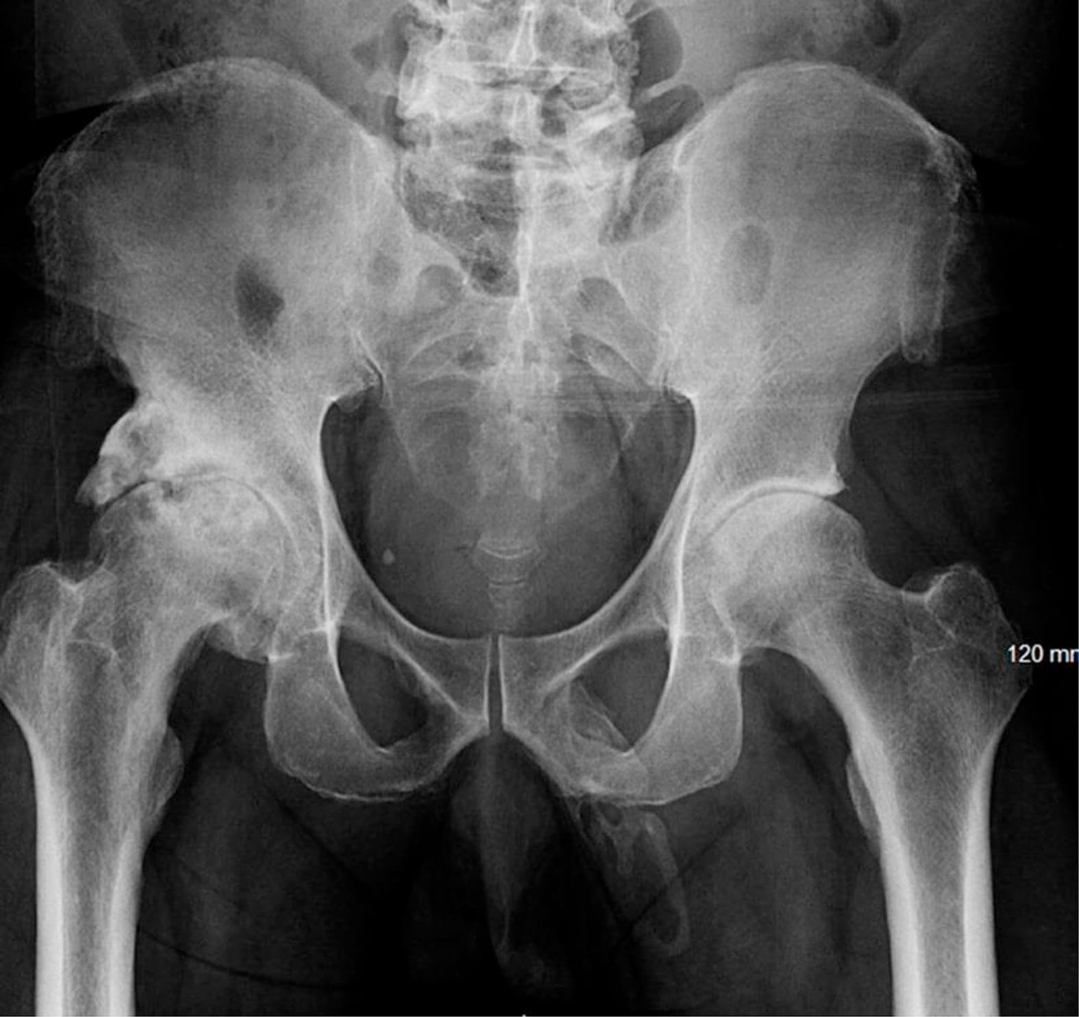 Após queda, homem descobre que seu pênis está se transformando em osso