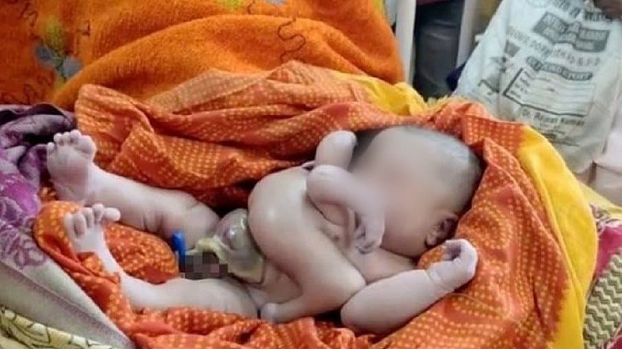 Bebê com quatro braços e quatro pernas é tratado como Deus na Índia