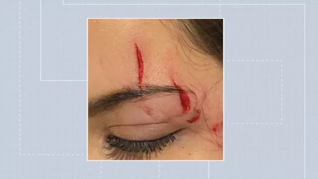 Mulher é atingida por drone durante show e precisa passar por cirurgia