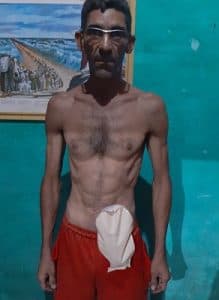 Paciente ostomizado recebe doações de bolsas de colostomia e denuncia situação crítica da saúde pública do RN