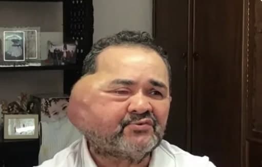 Idoso com tumor gigante no rosto tem cirurgia agendada no RN após batalha judicial