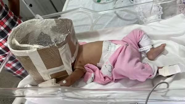 ‘Mais comum do que se imagina', diz médica sobre improvisar ‘respiradores' em hospitais
